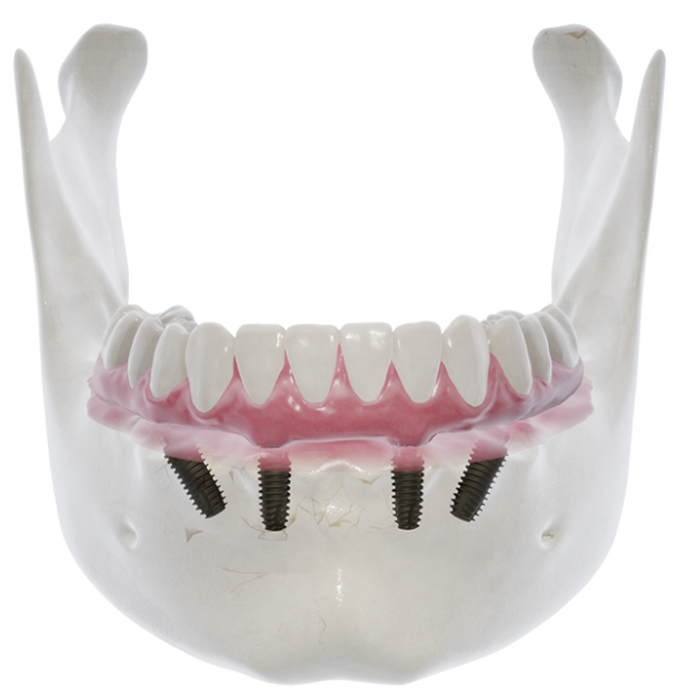 総入れ歯か総インプラントか | ブログ | 市川市の妙典エリアの歯医者
