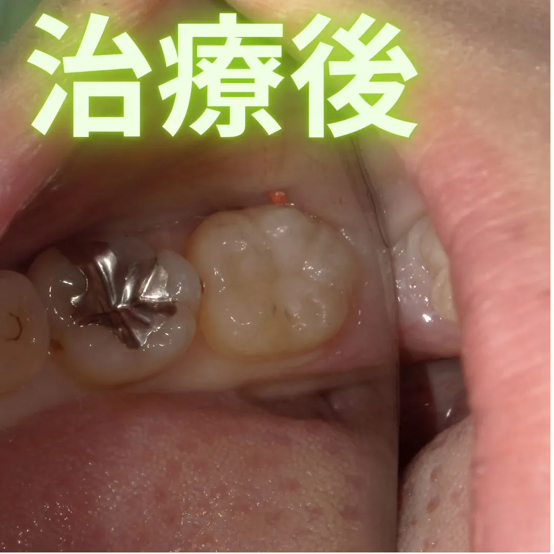 銀歯の下に潜む虫歯