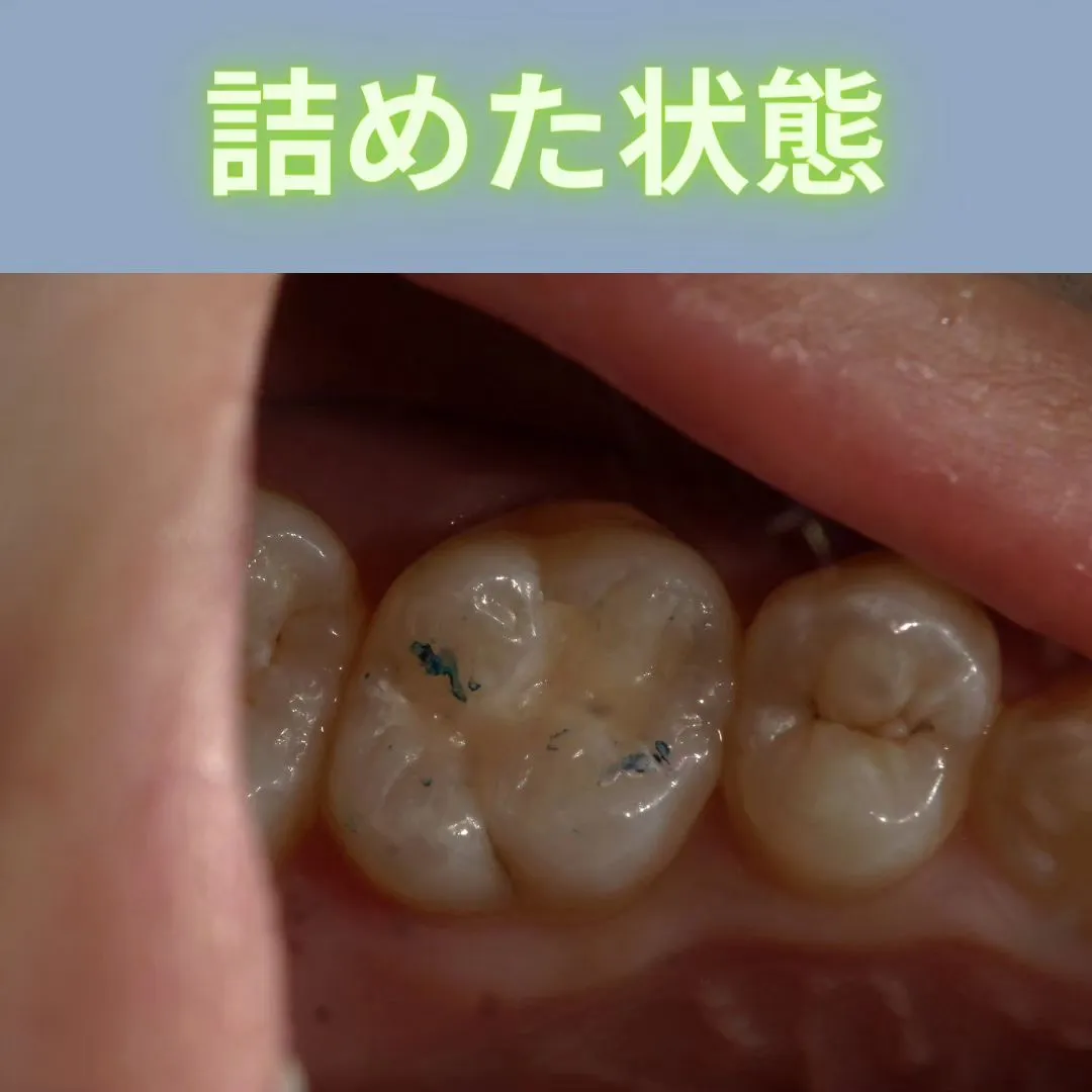 一般的な虫歯治療