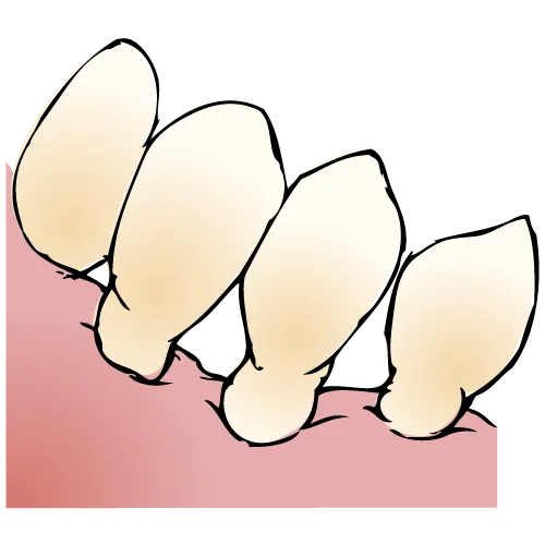 歯茎下がりによる影響