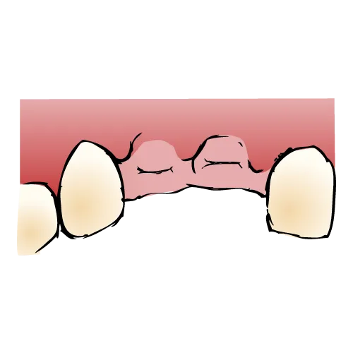 インプラントができるまでの流れ