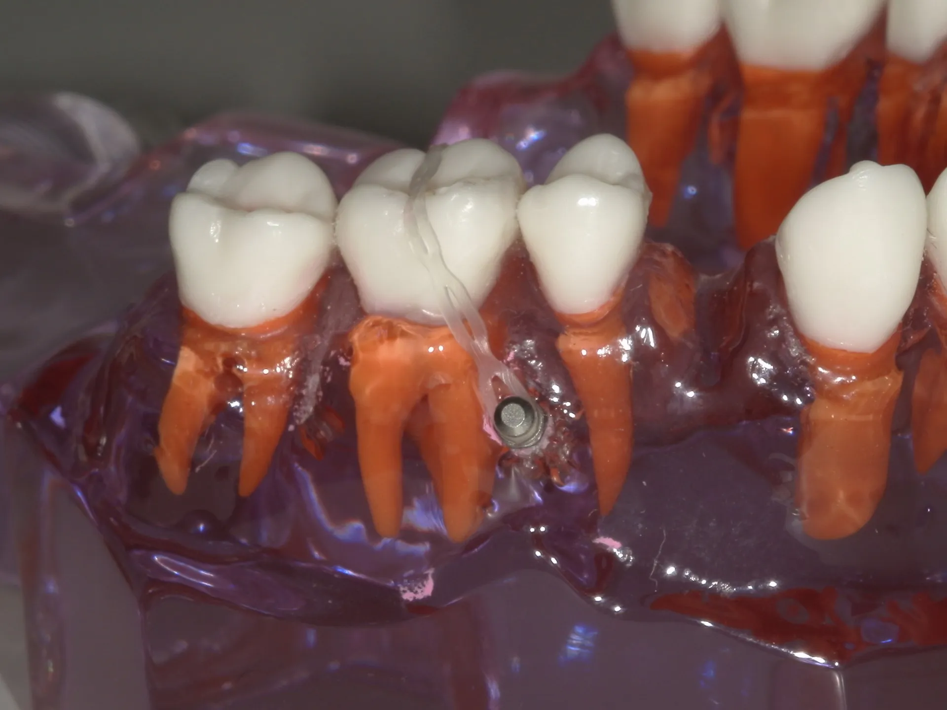 挺出歯の治療法