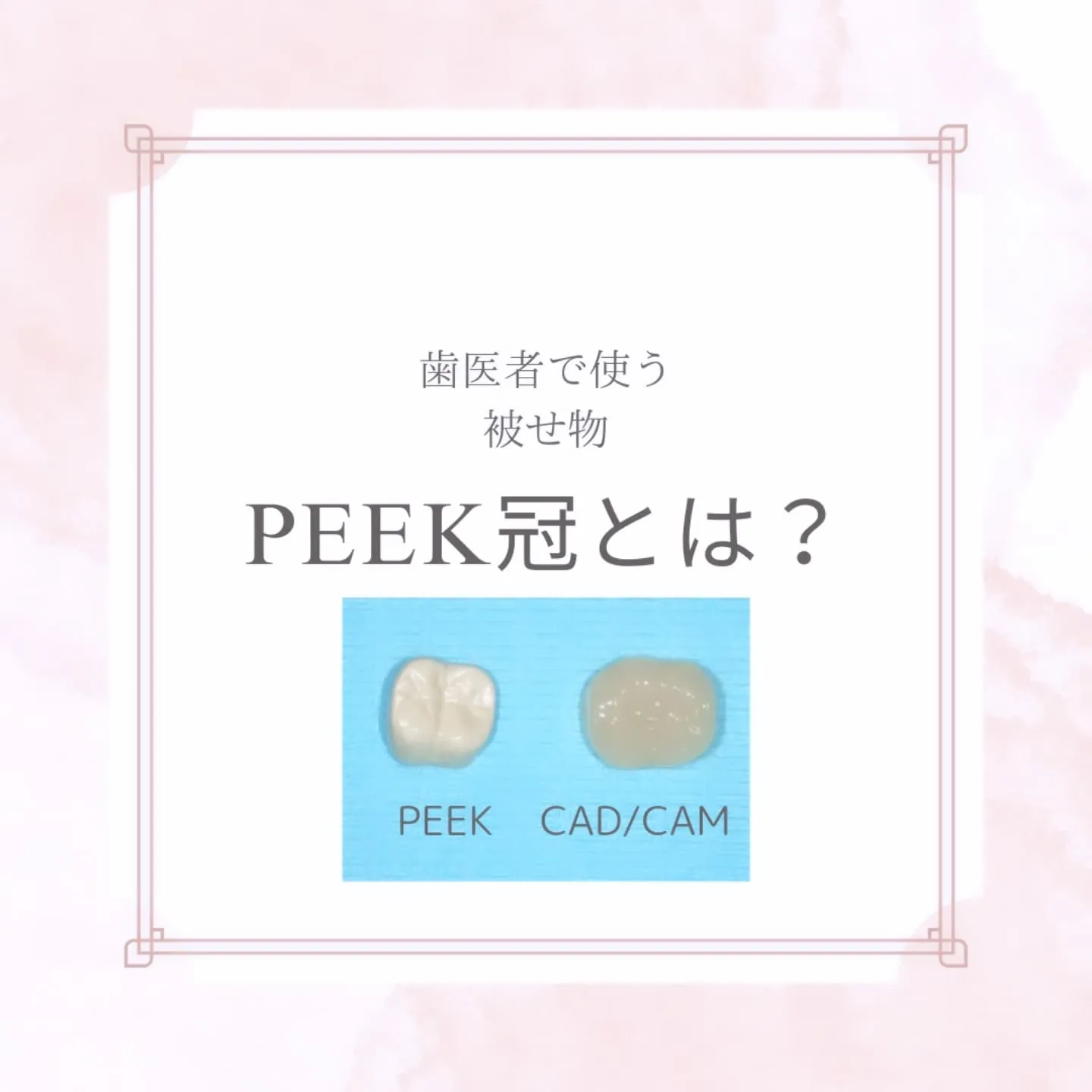 歯医者で使う！PEEK冠とは？