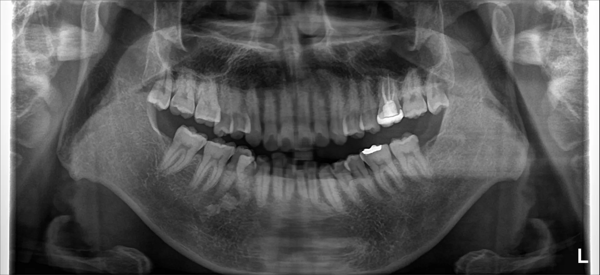 親知らず抜歯は一般歯科では紹介状？？