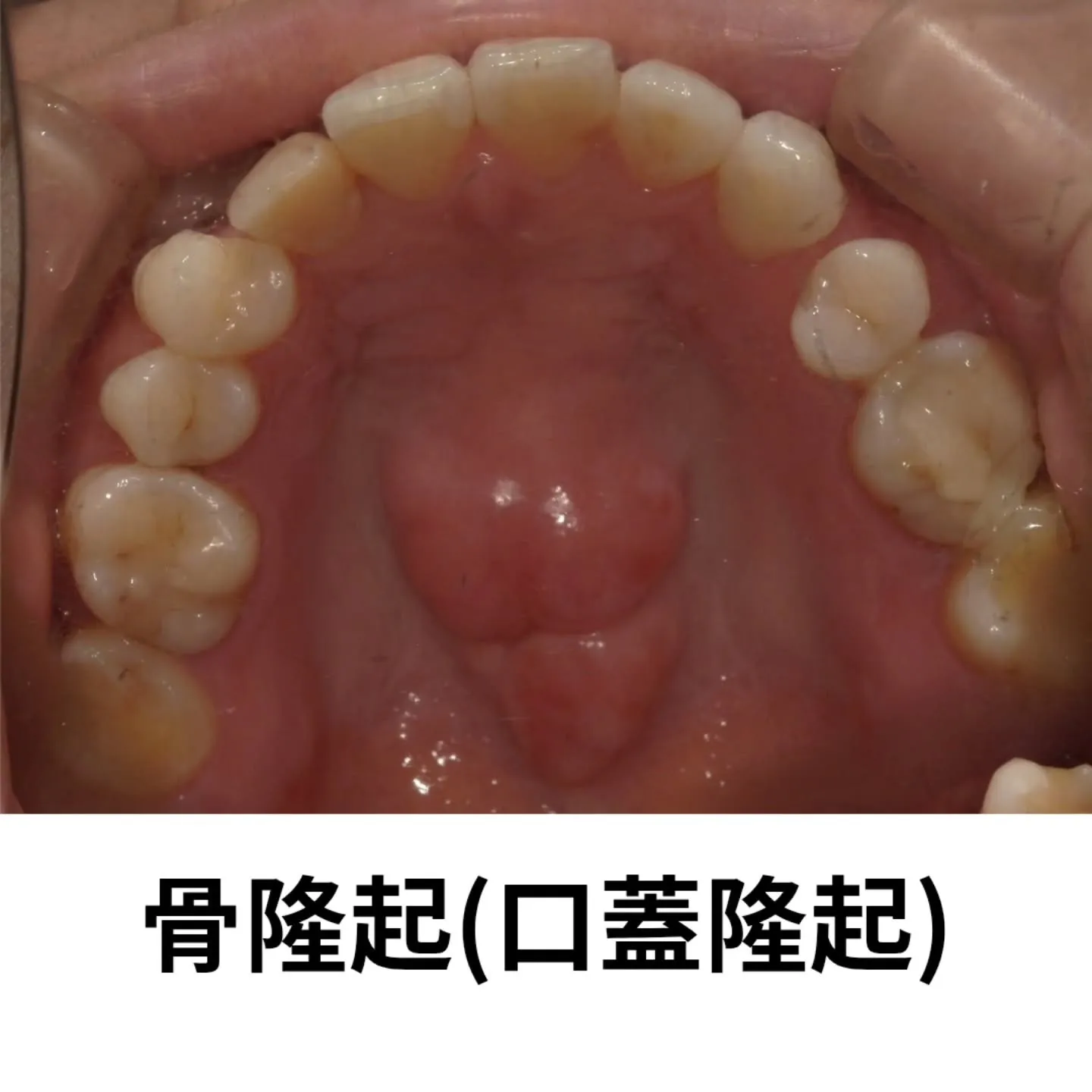 痛くないけど、口の中が腫れてる？？