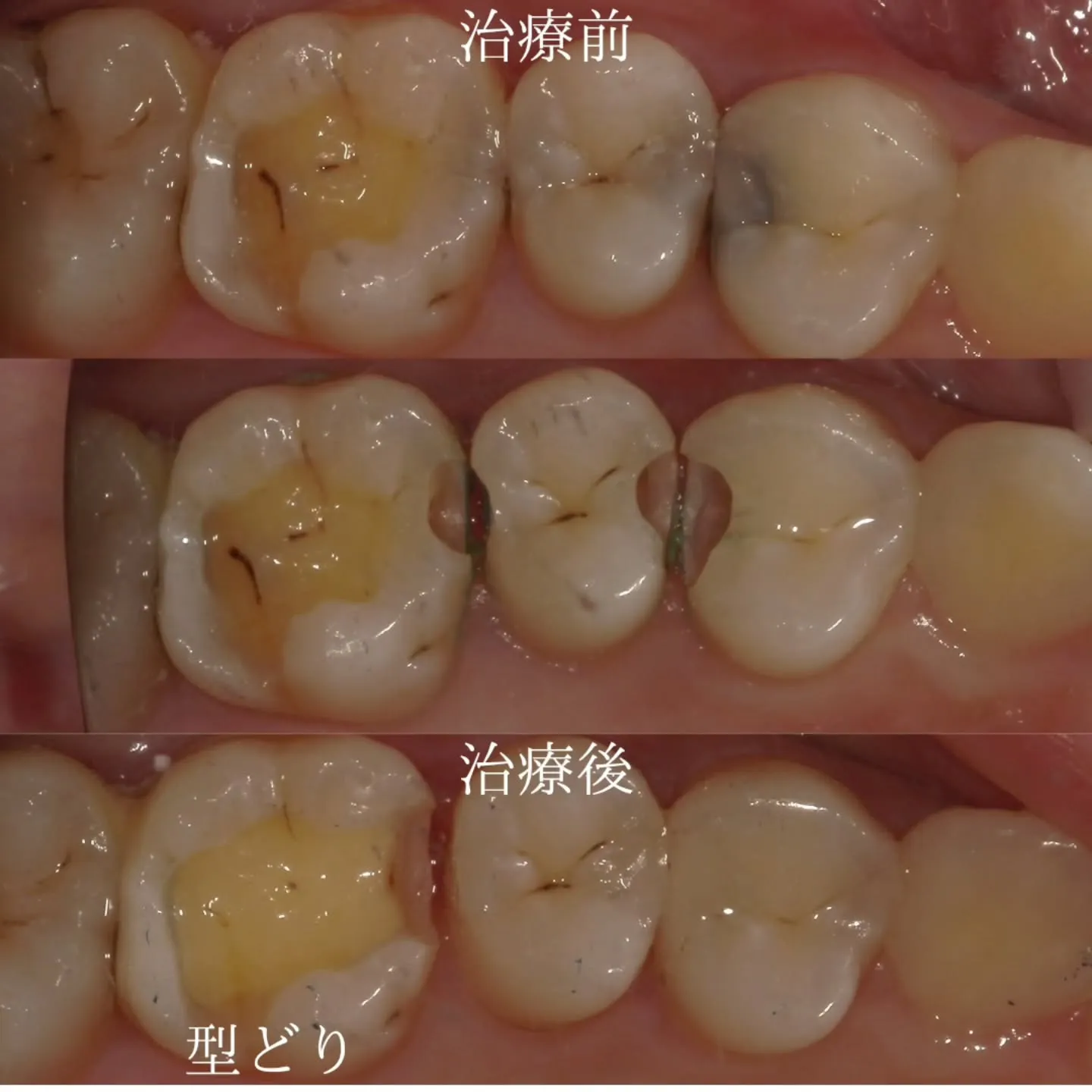 歯の間にできる連続した虫歯の治療法