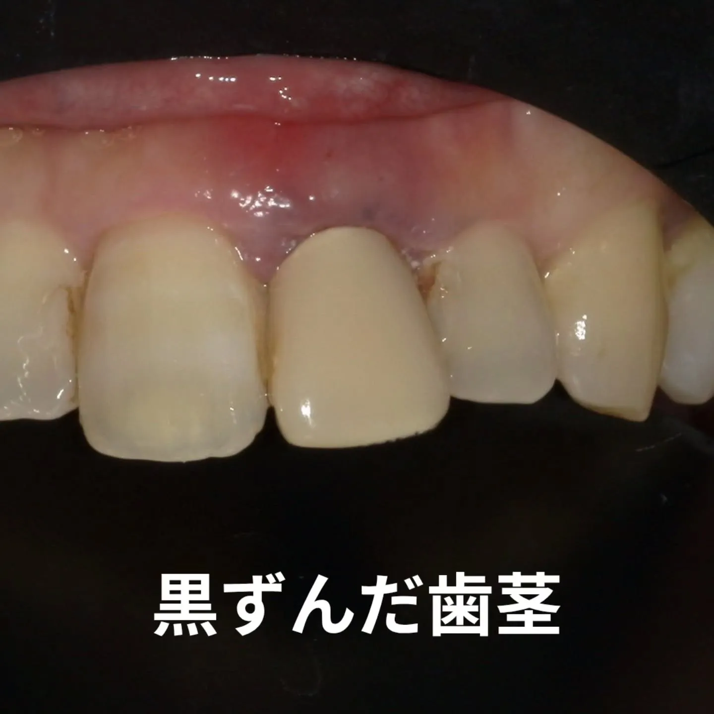 黒ずんだ歯茎はどうして起きる？