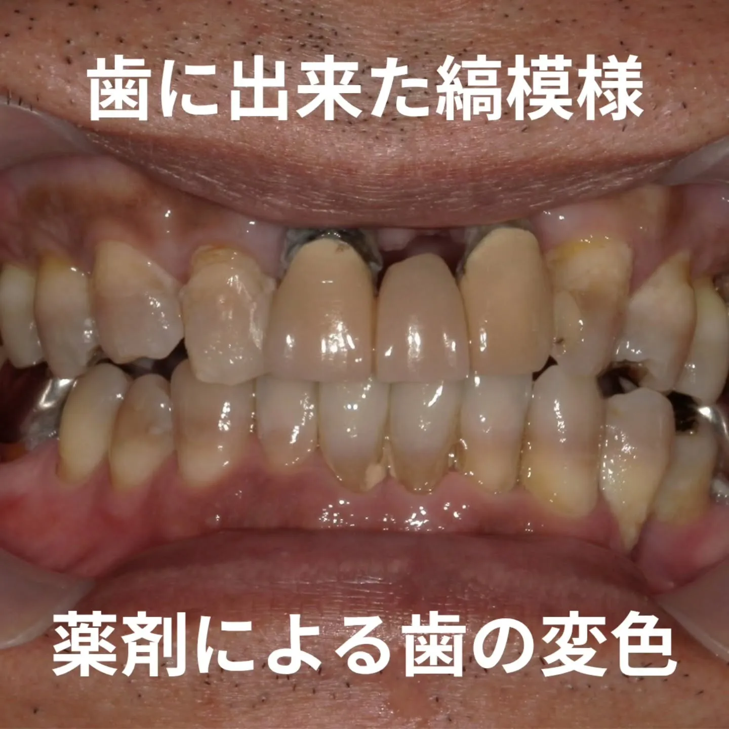 薬剤による歯の縞模様(変色)！？