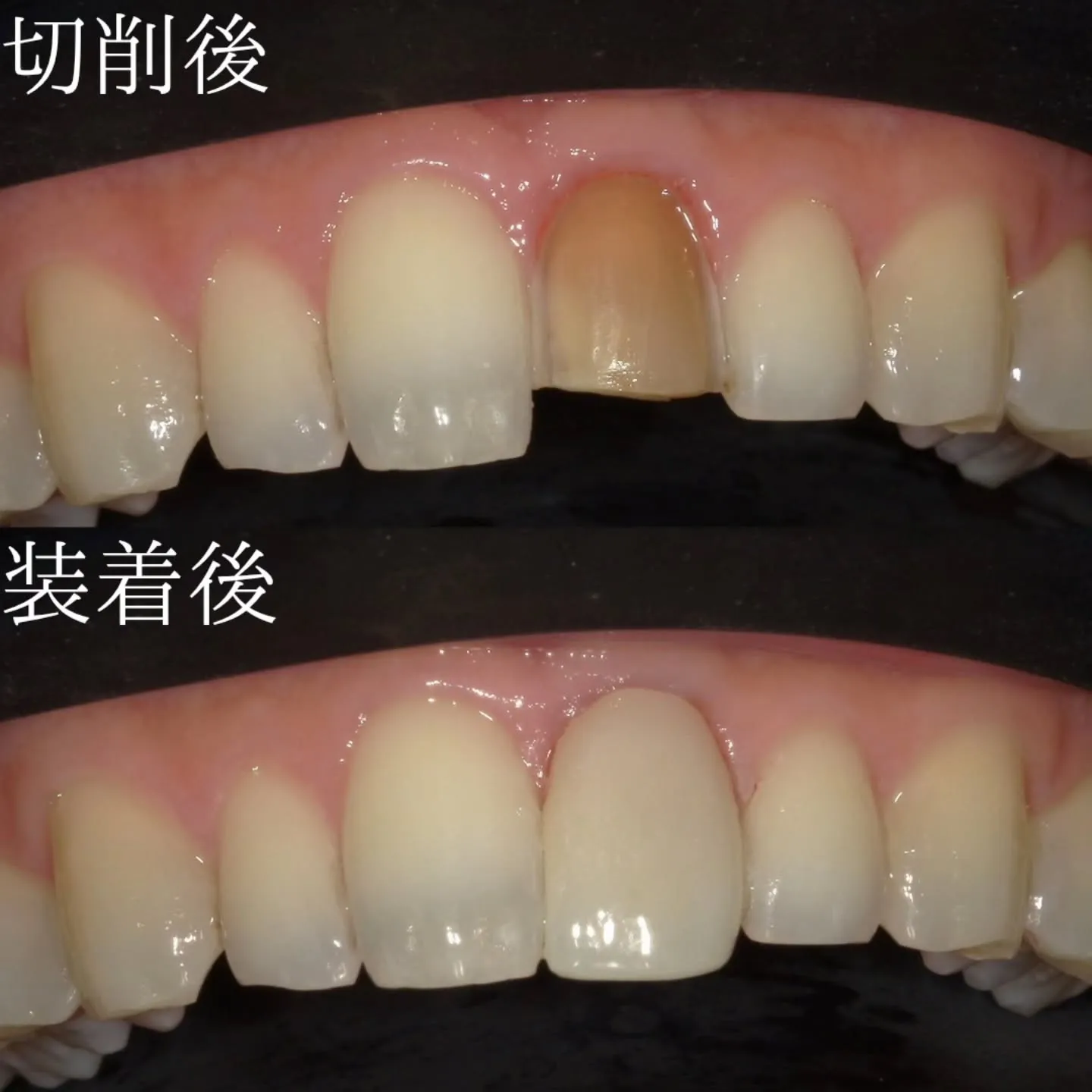 変色歯とラミネートベニア