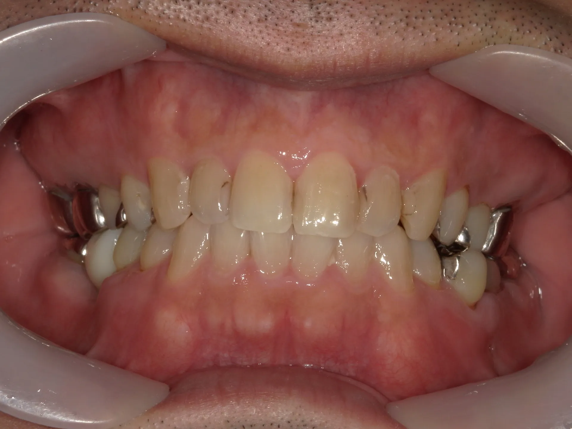 抜歯からインプラントを入れるまで