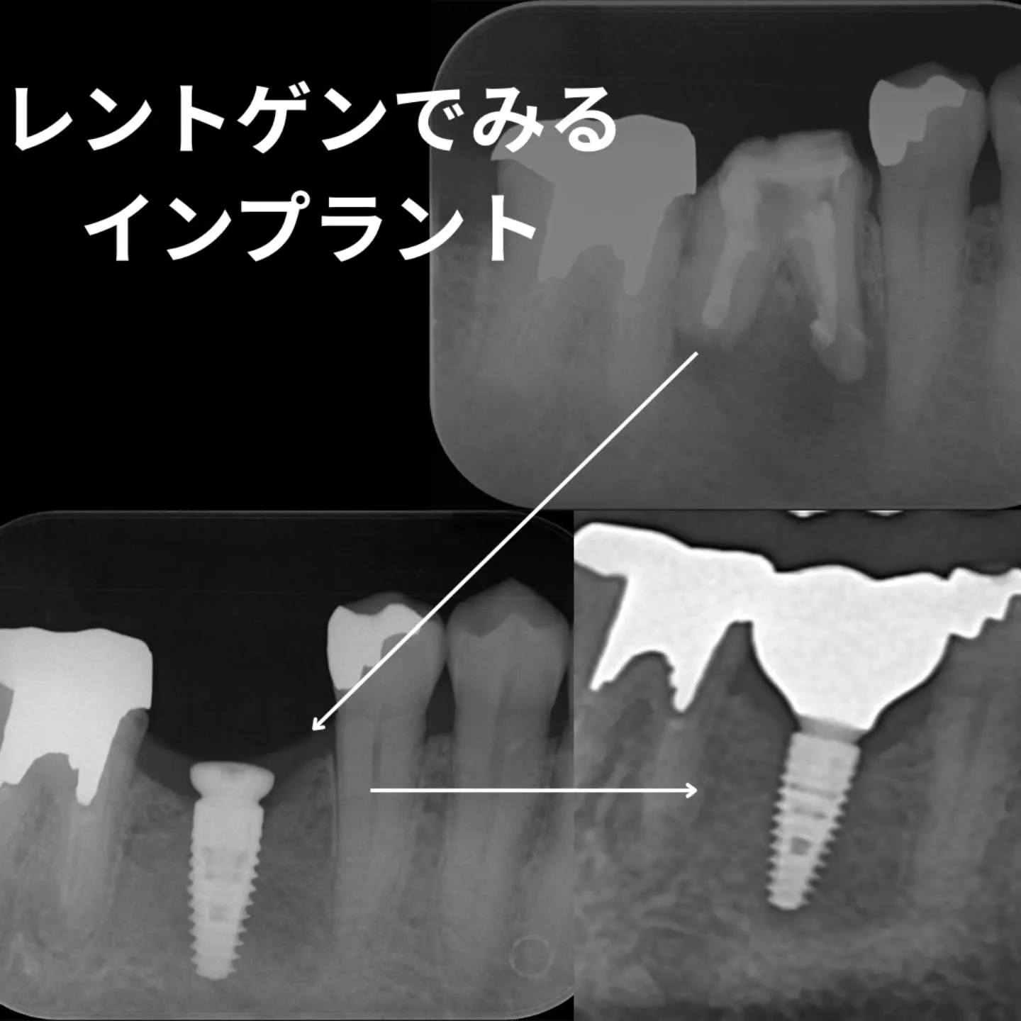 インプラント治療の流れ