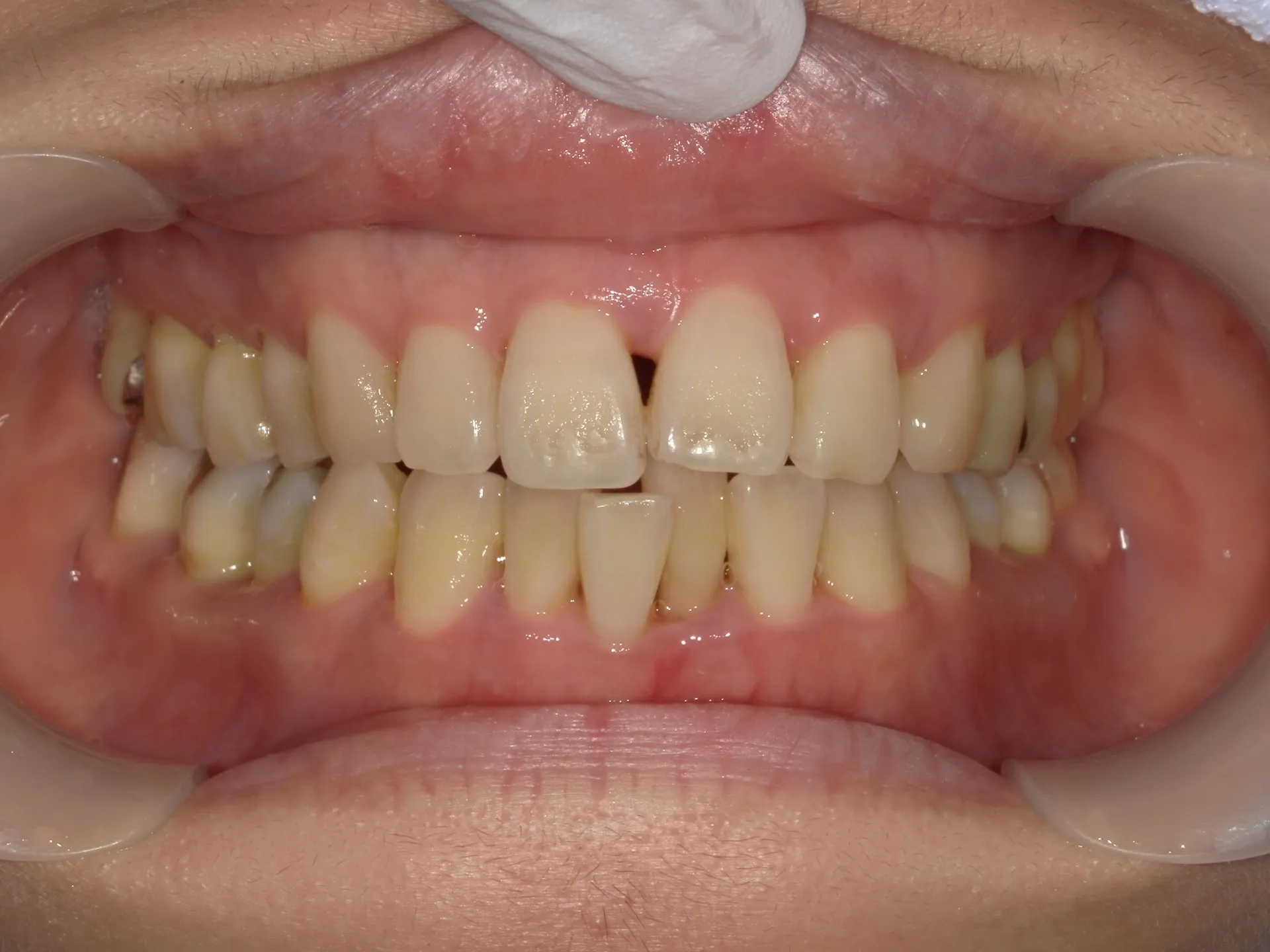 歯周病治療中の矯正治療