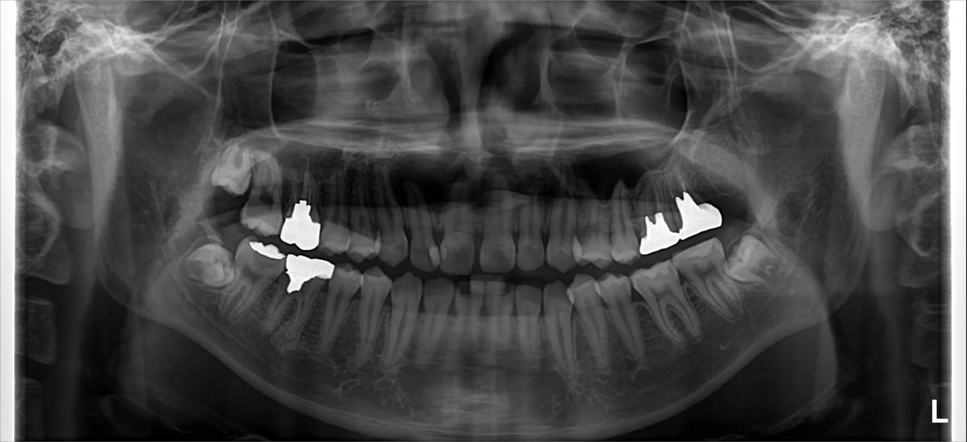 巨大な歯根膿瘍の根管治療1.5年経過症例