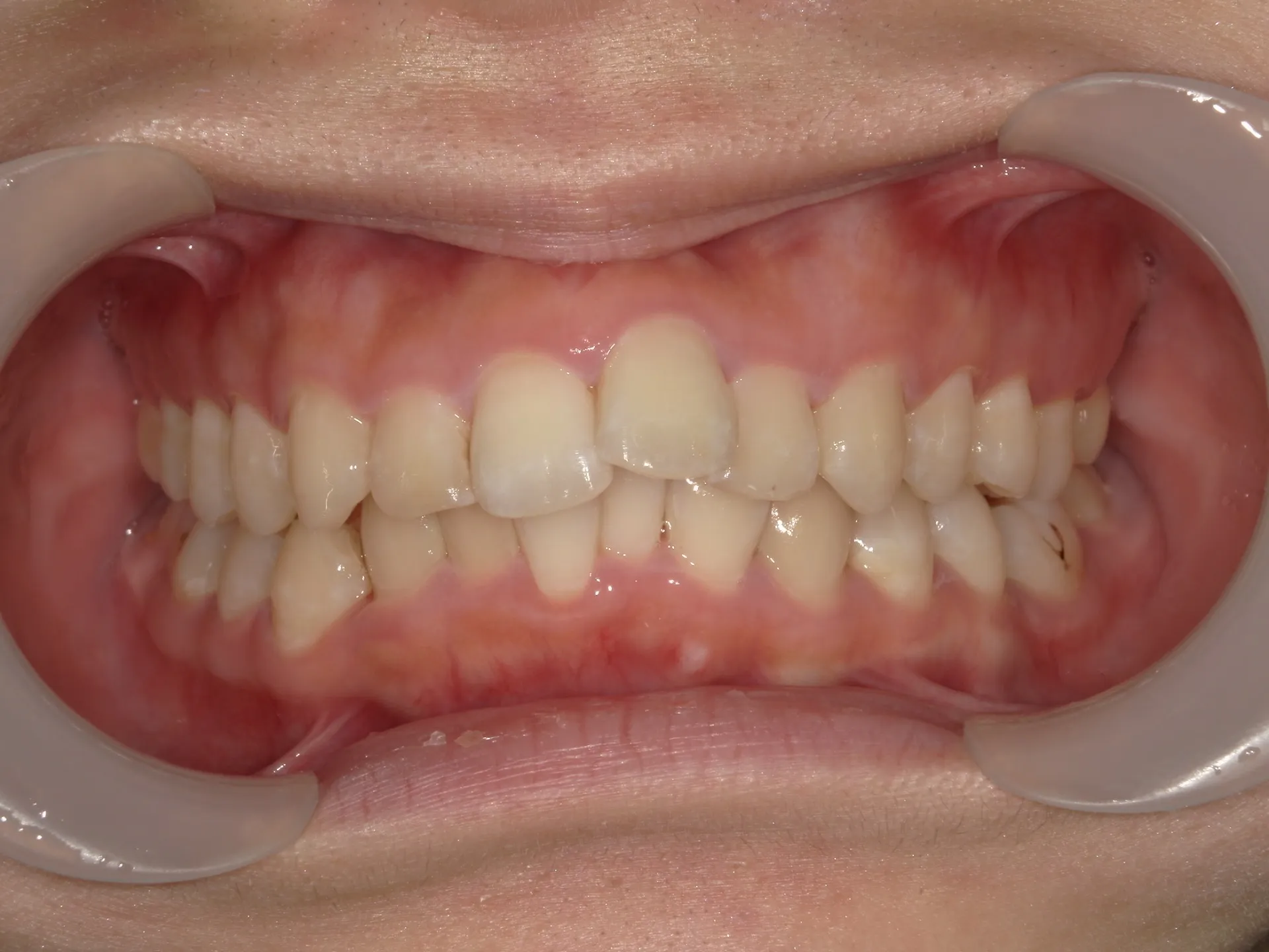 矯正治療で印象を変える！！