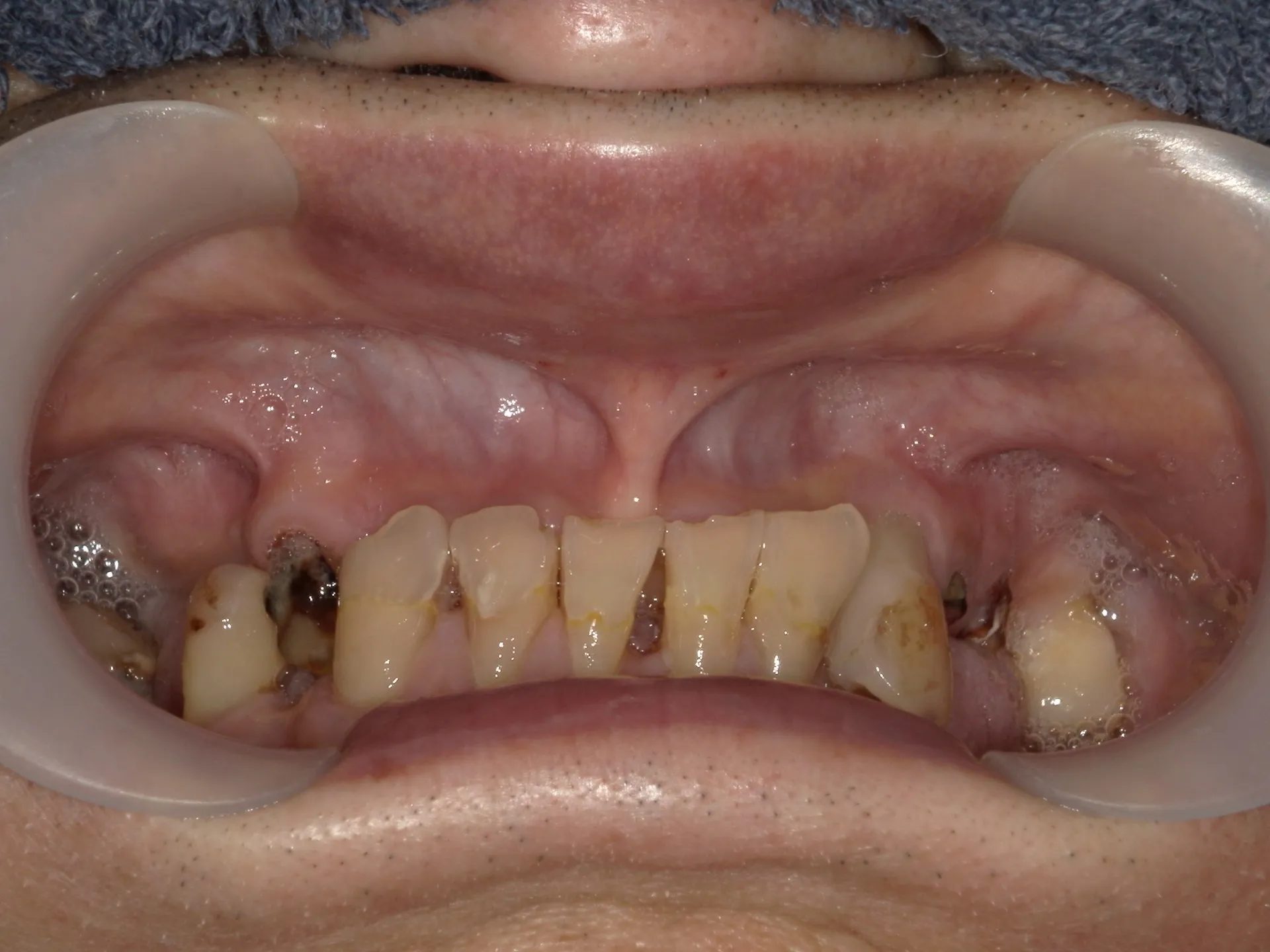 すれ違い咬合で全く噛めなかった状態を噛めるまで