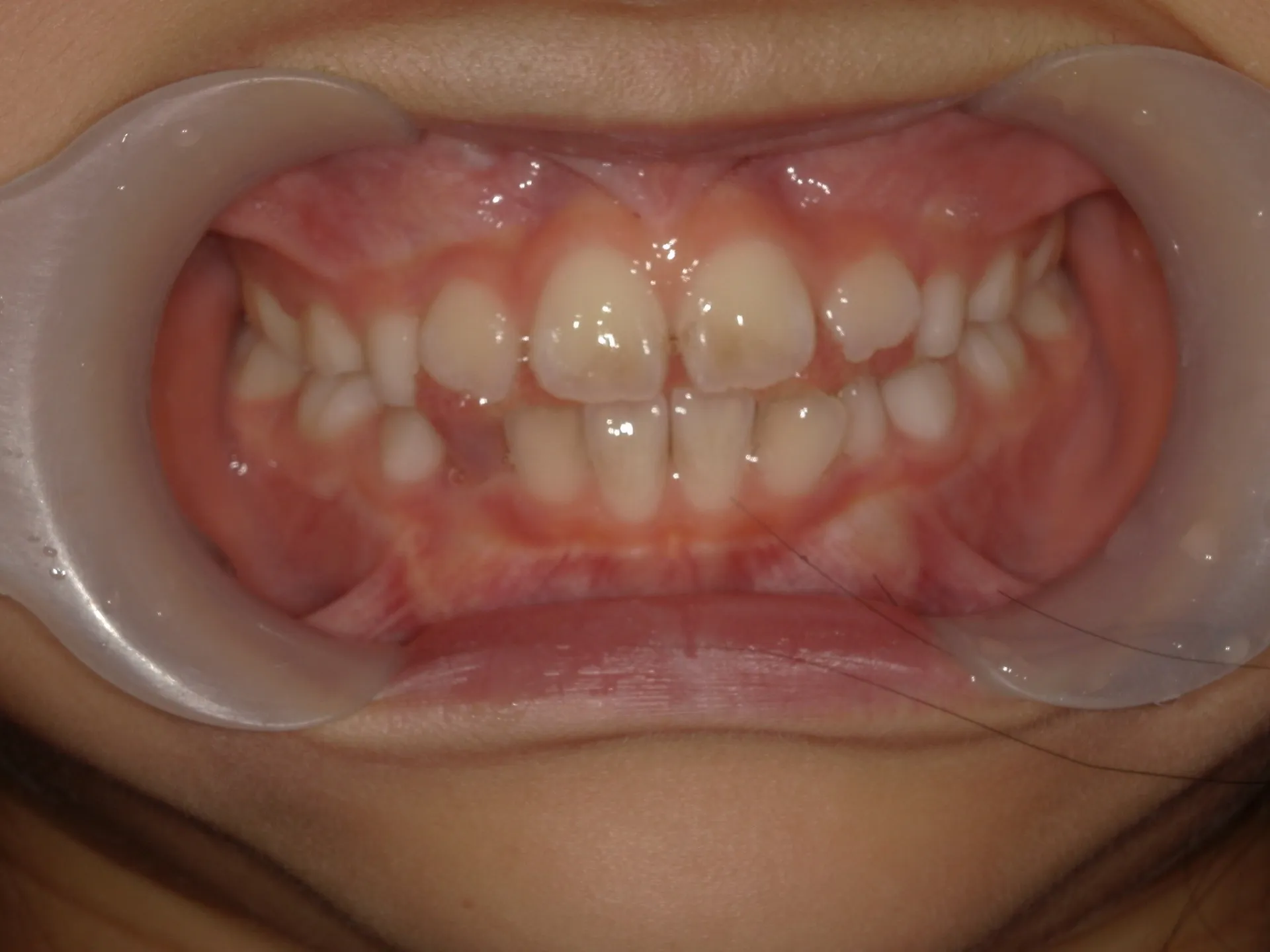 歯と歯の間から舌が見える？舌突出癖とは？