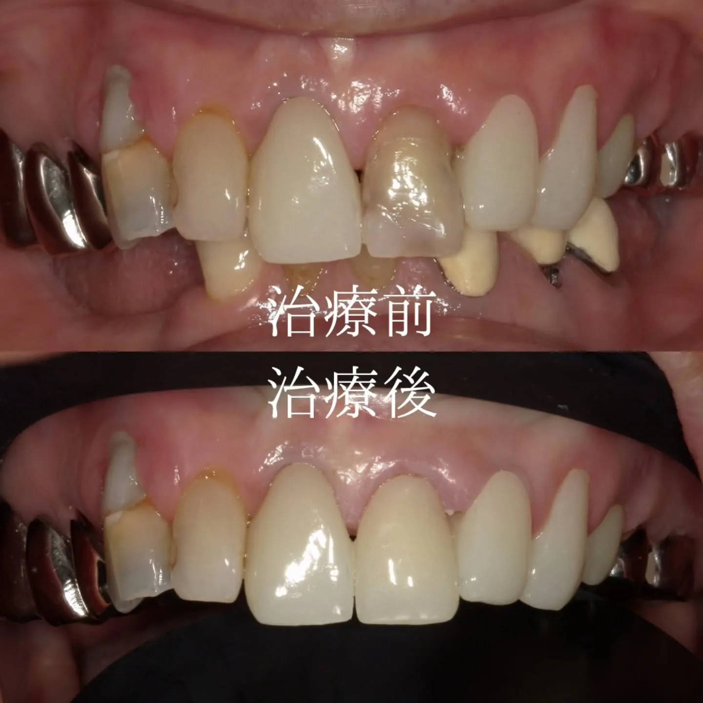 天然歯よりもセラミッククラウンの方がキレイ？？