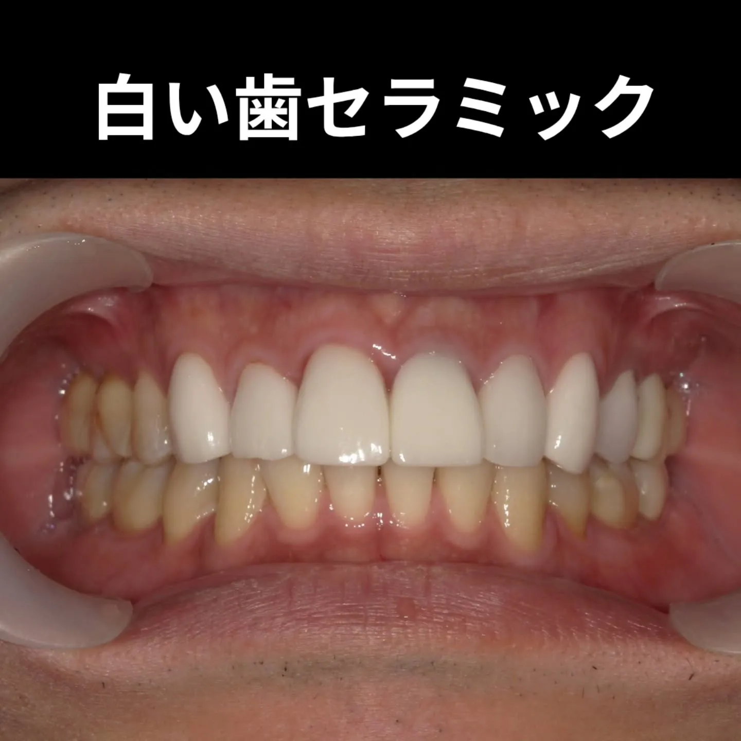 白い歯セラミック✨️