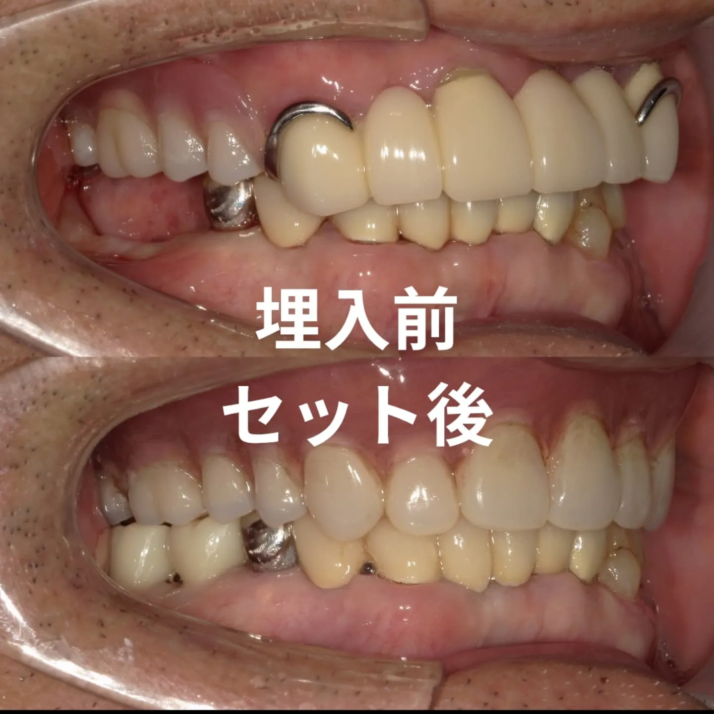 奥歯のインプラント