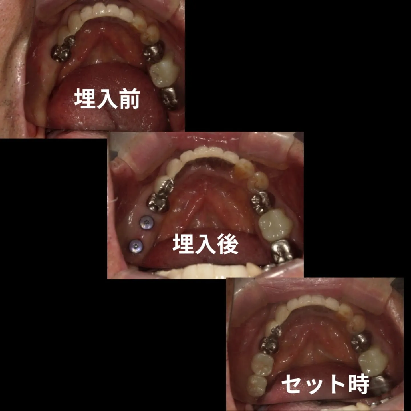 奥歯のインプラント