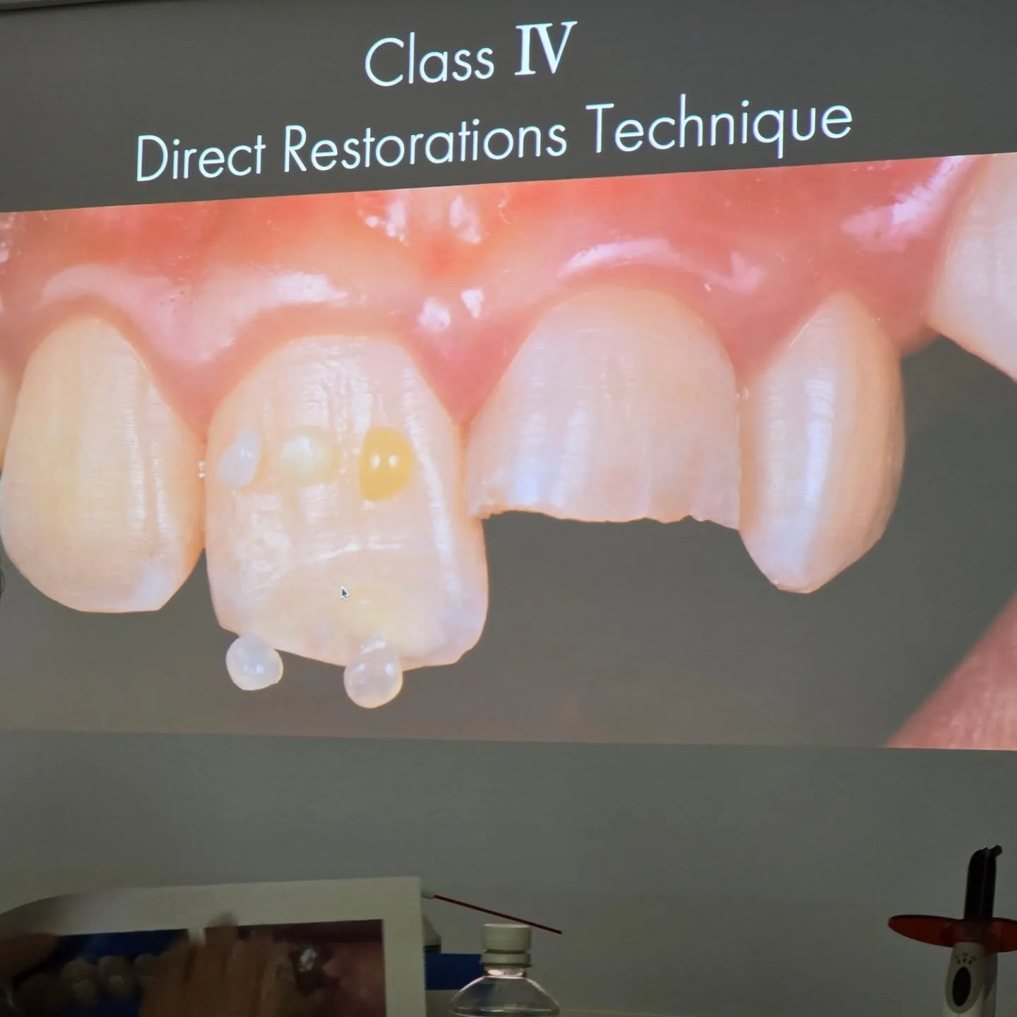 ダイレクトボンディング！