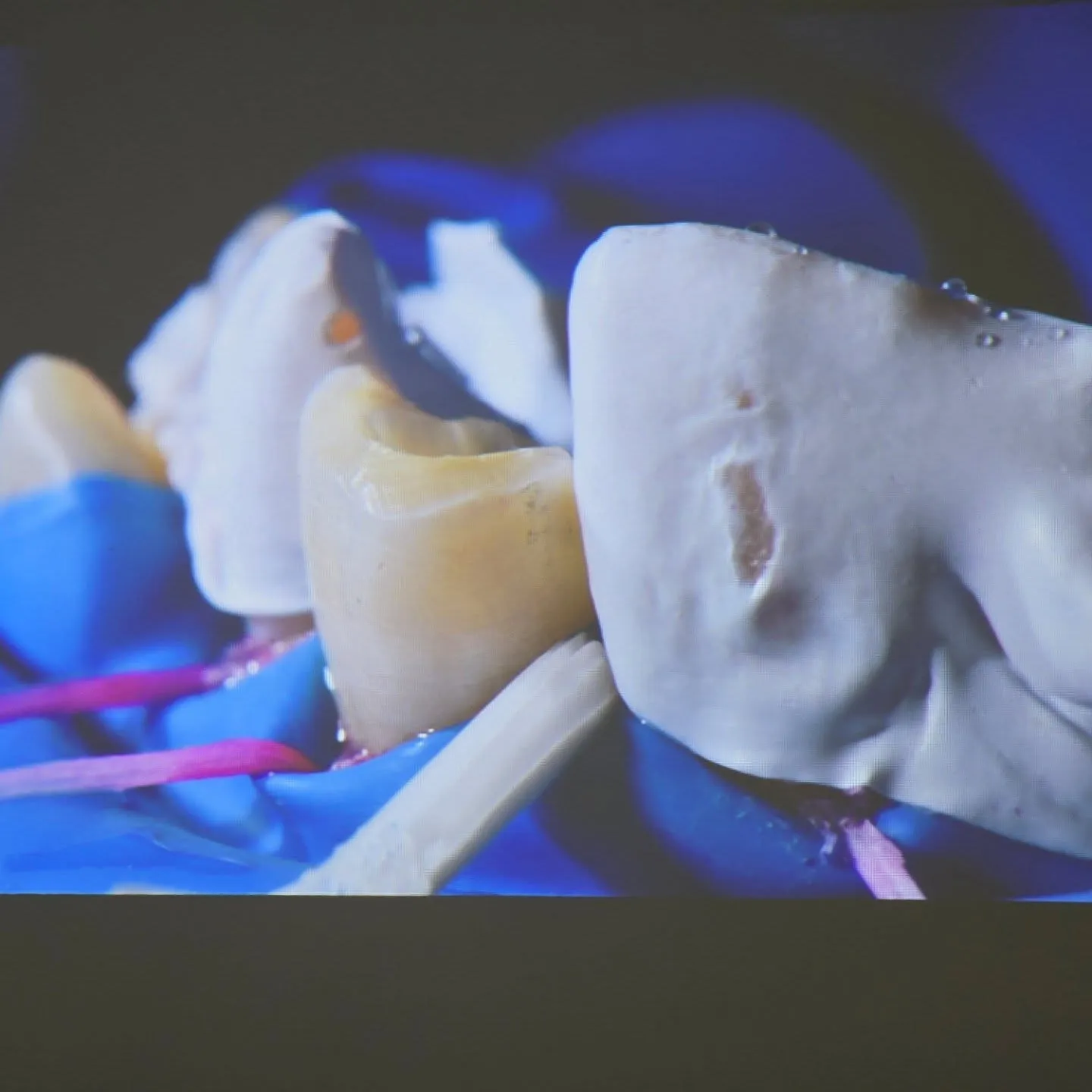 ダイレクトボンディング！