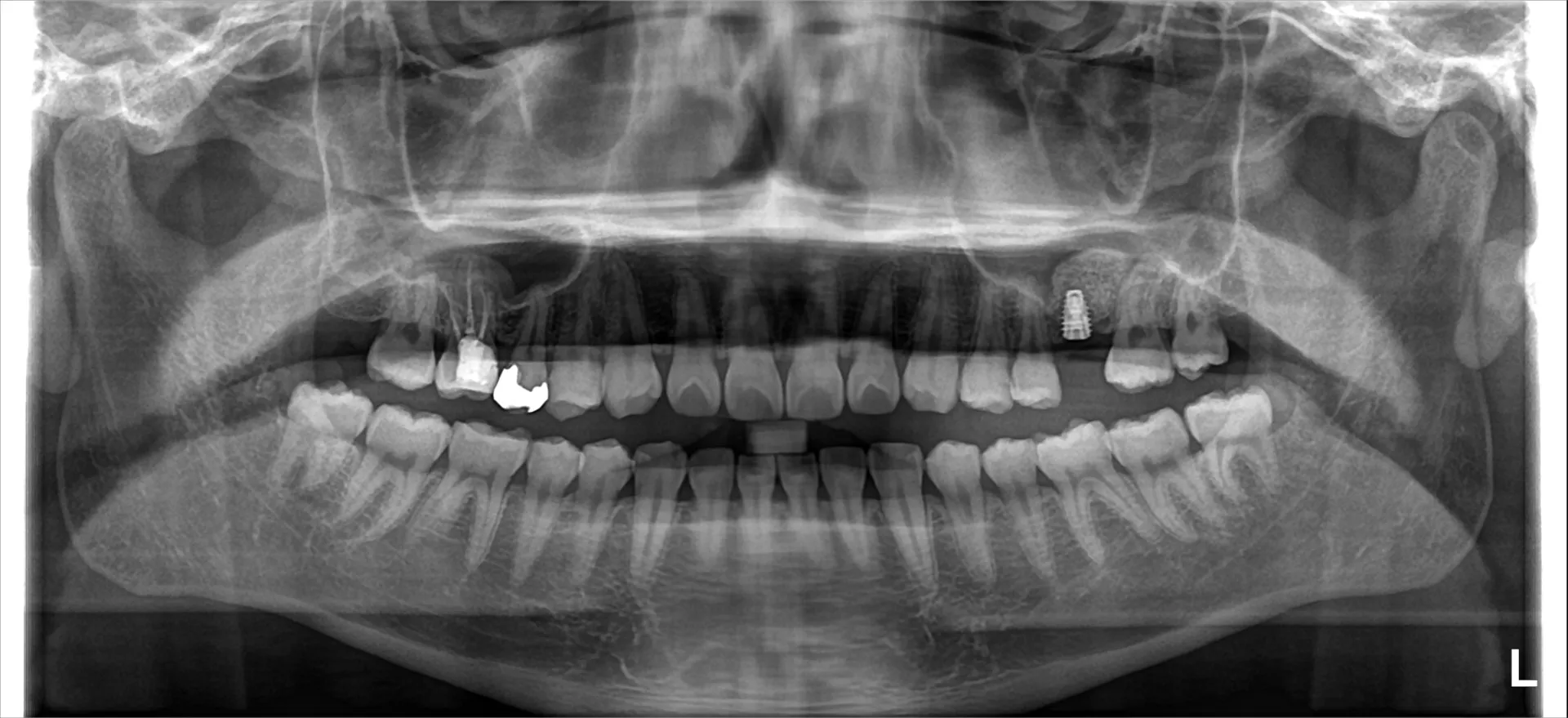 親知らずが移植に使える？！