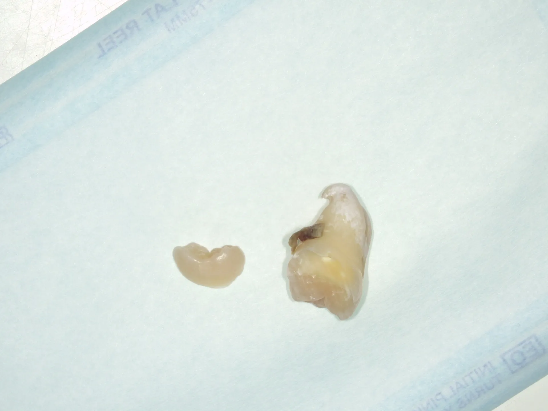 抜歯しにくい親知らずの根っこの形