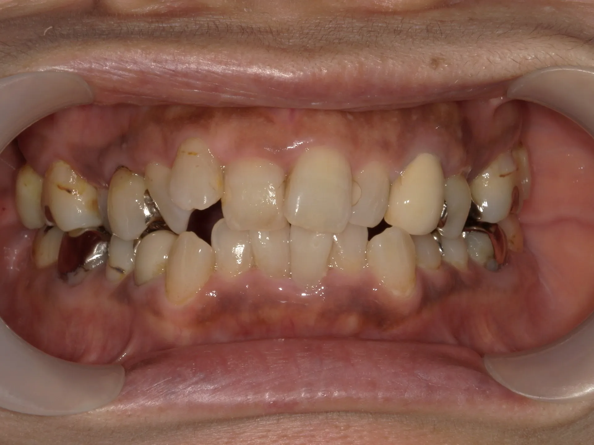 矯正治療は若くないとできないなんてことはない！！