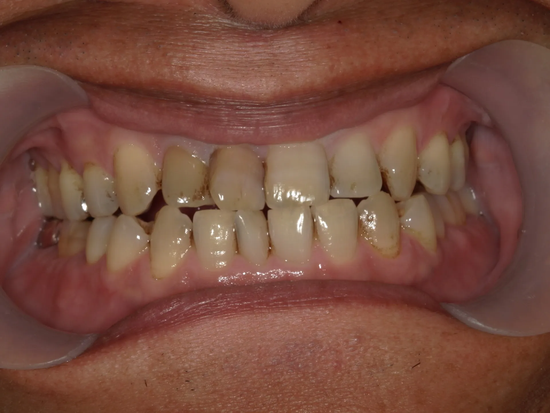 保険の歯のクリーニングと自費のPMTCでは何が違う？？