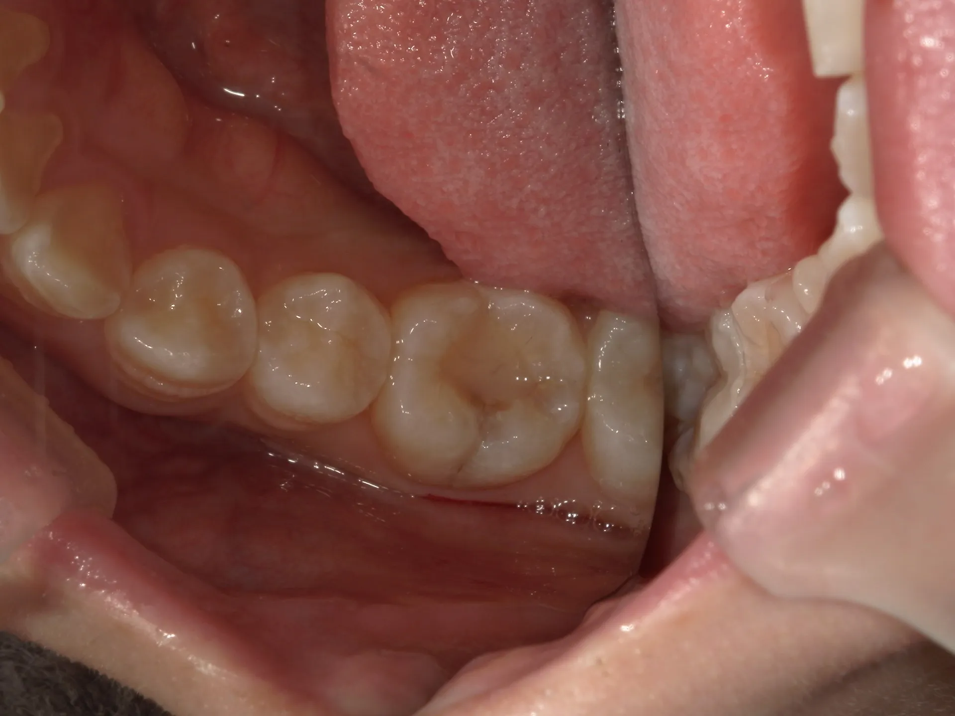 古い詰め物の下に虫歯がある？！