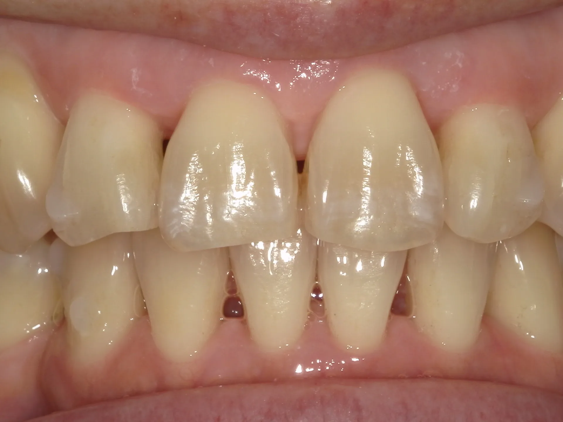 歯の表面にあるホワイトスポット