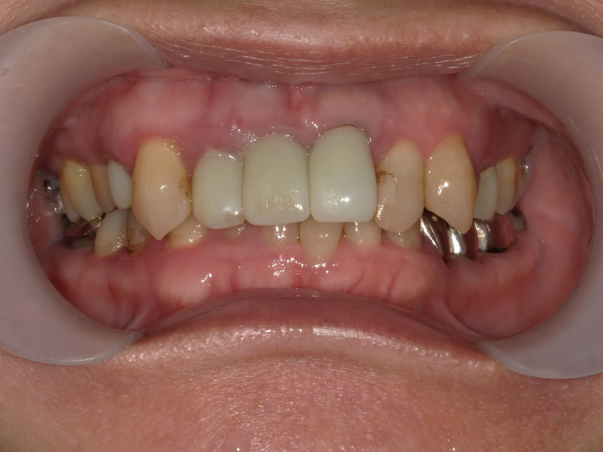 色んな色した歯