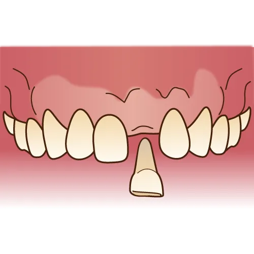 歯が抜けた！そのまま戻したらくっつくの？！