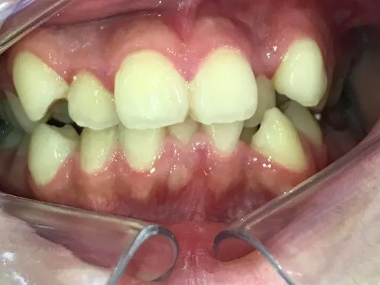 先天欠如の矯正治療