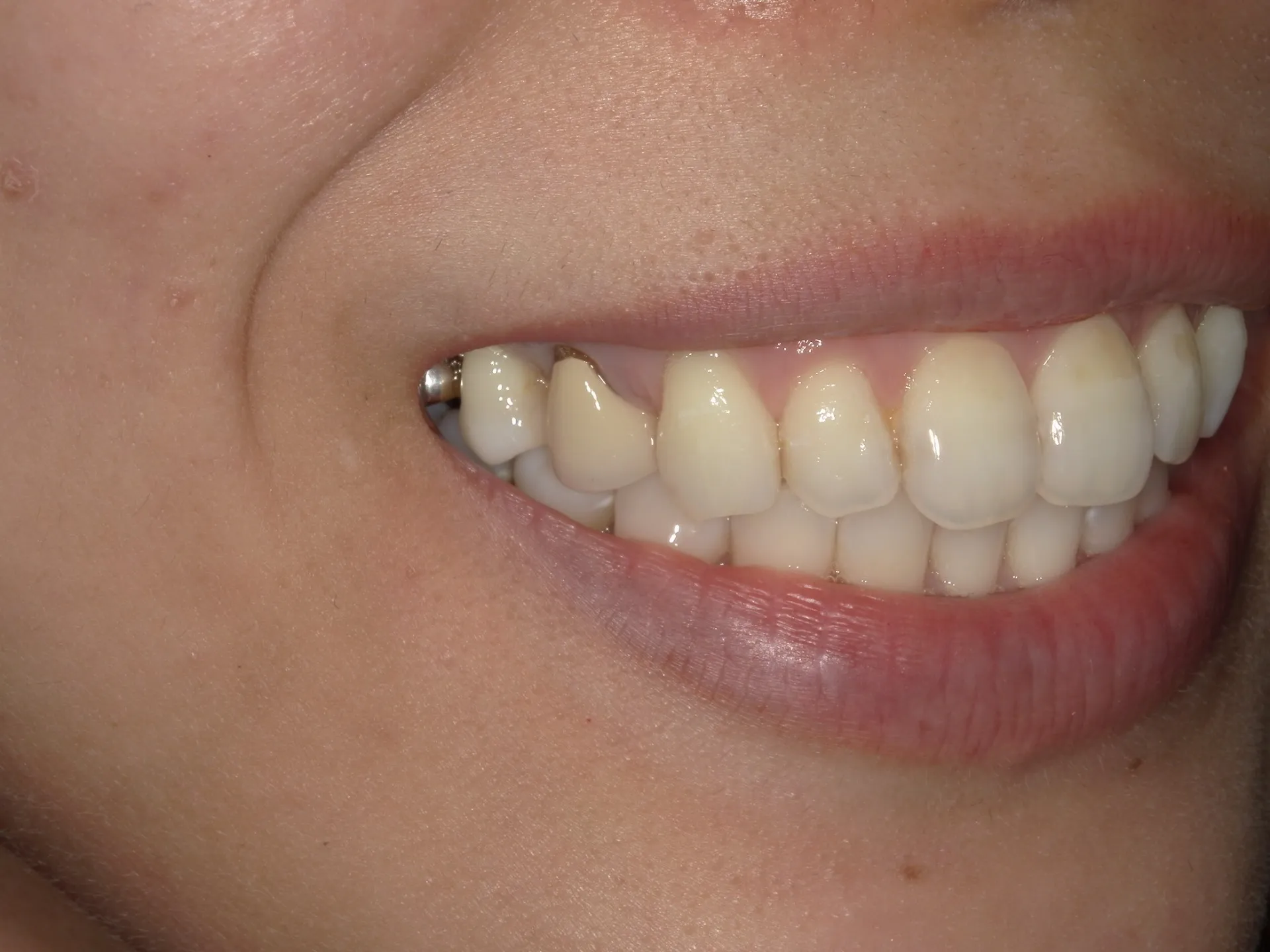 銀歯はどこまで見える？