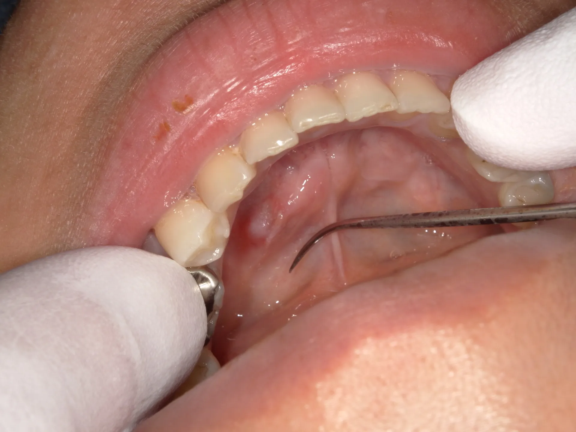 舌の下が腫れる「ガマ腫」とは？