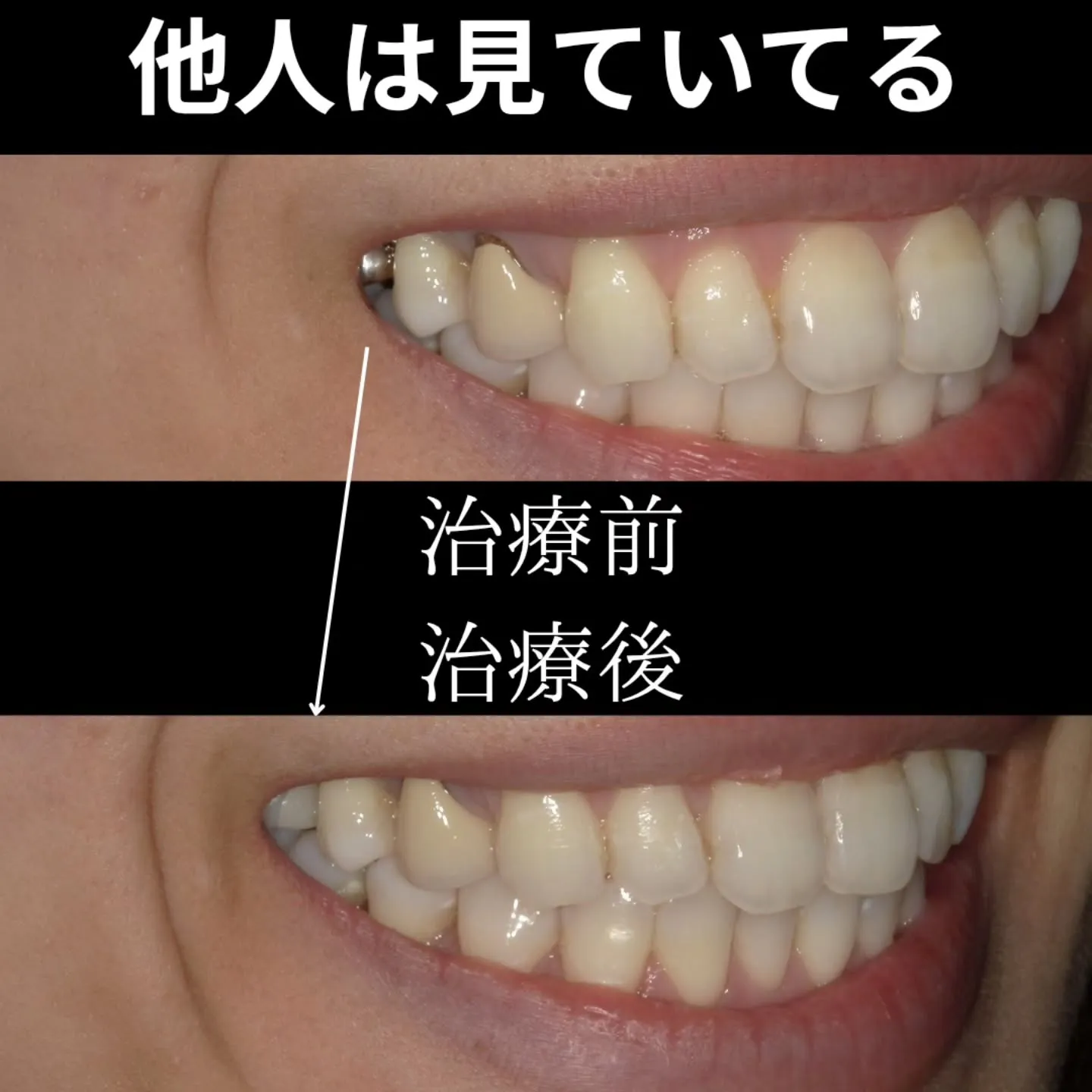 銀歯が見える範囲はどこまで？？