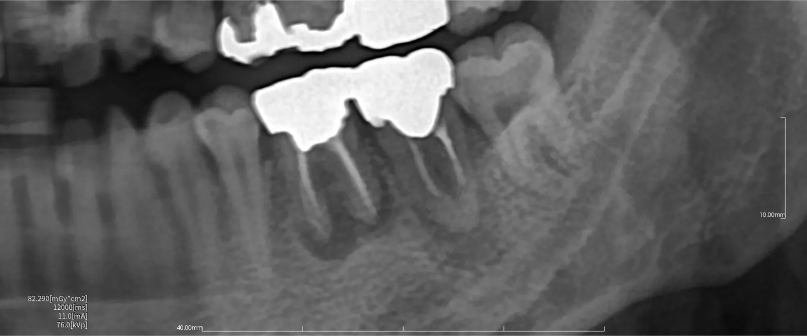 レントゲン写真で分かる！感染根管治療前後の骨の変化