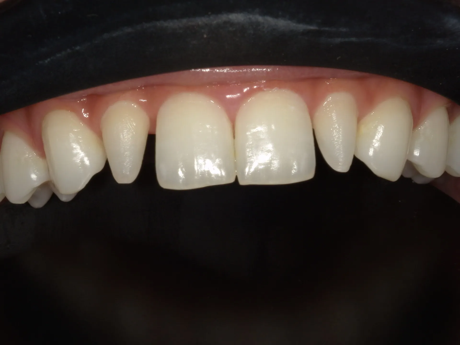 歯の色や形を変えたい！それぞれの治療法とは？