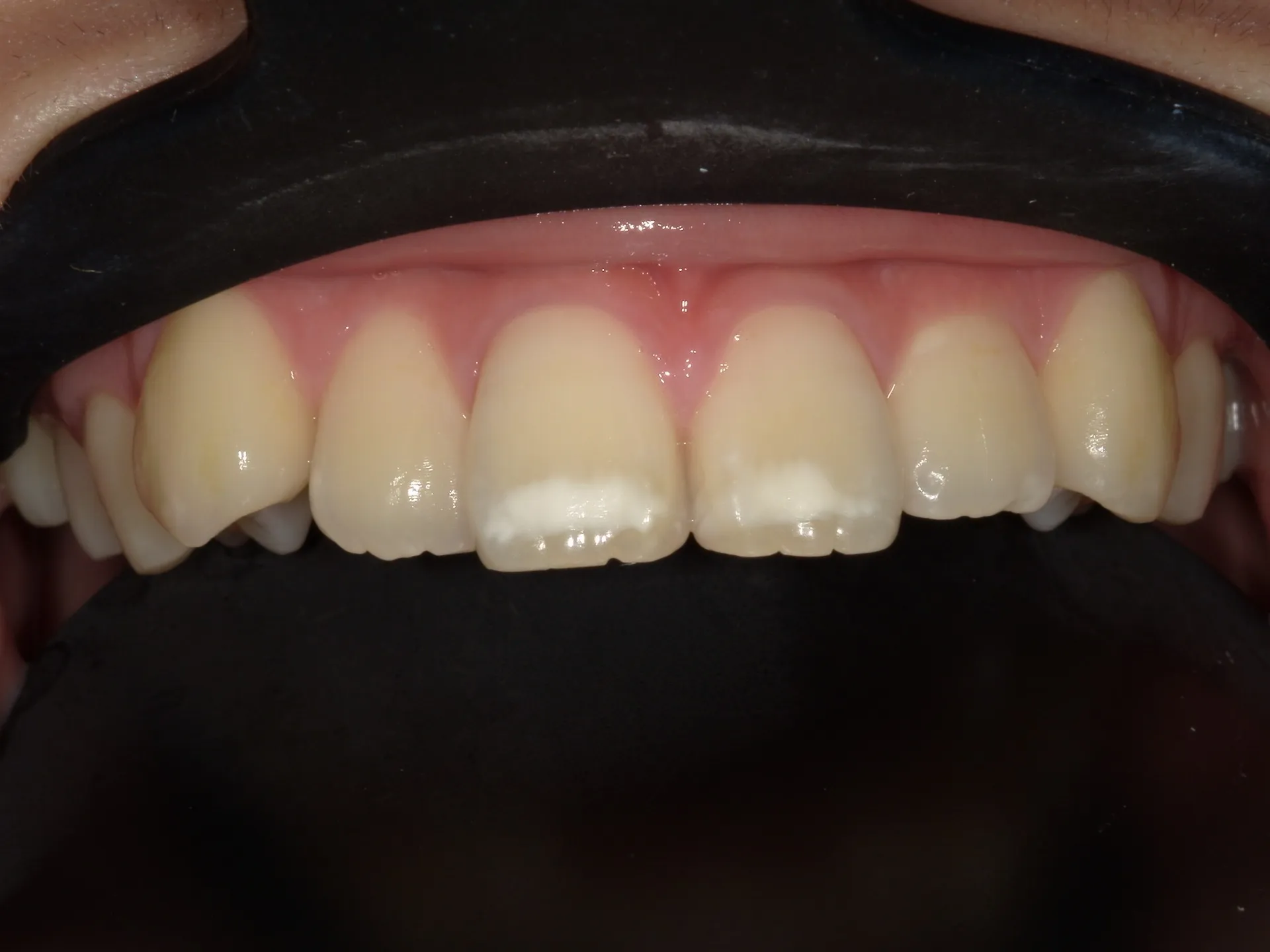 削らないホワイトスポット治療と限界