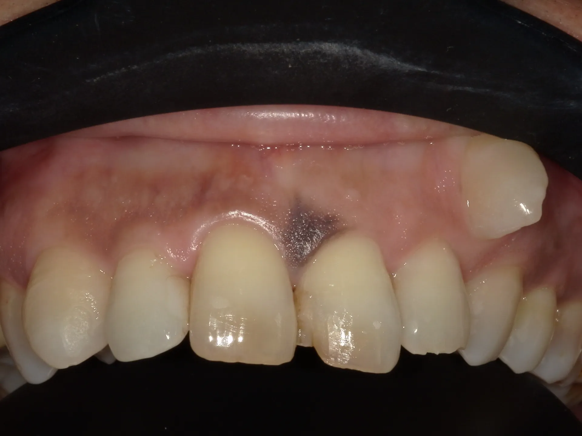 口の中にもホクロができる？！