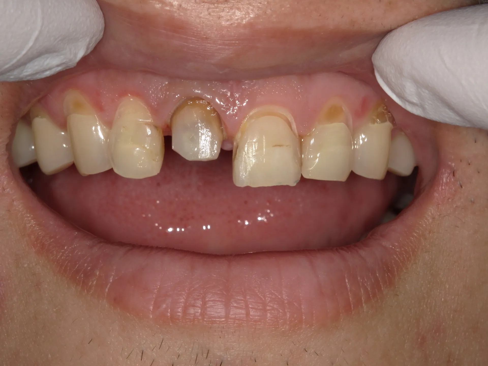 前歯が折れた。。