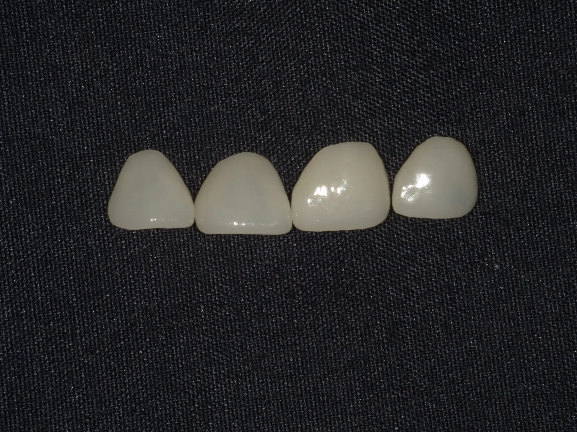 前歯の隙間をどう治す？？