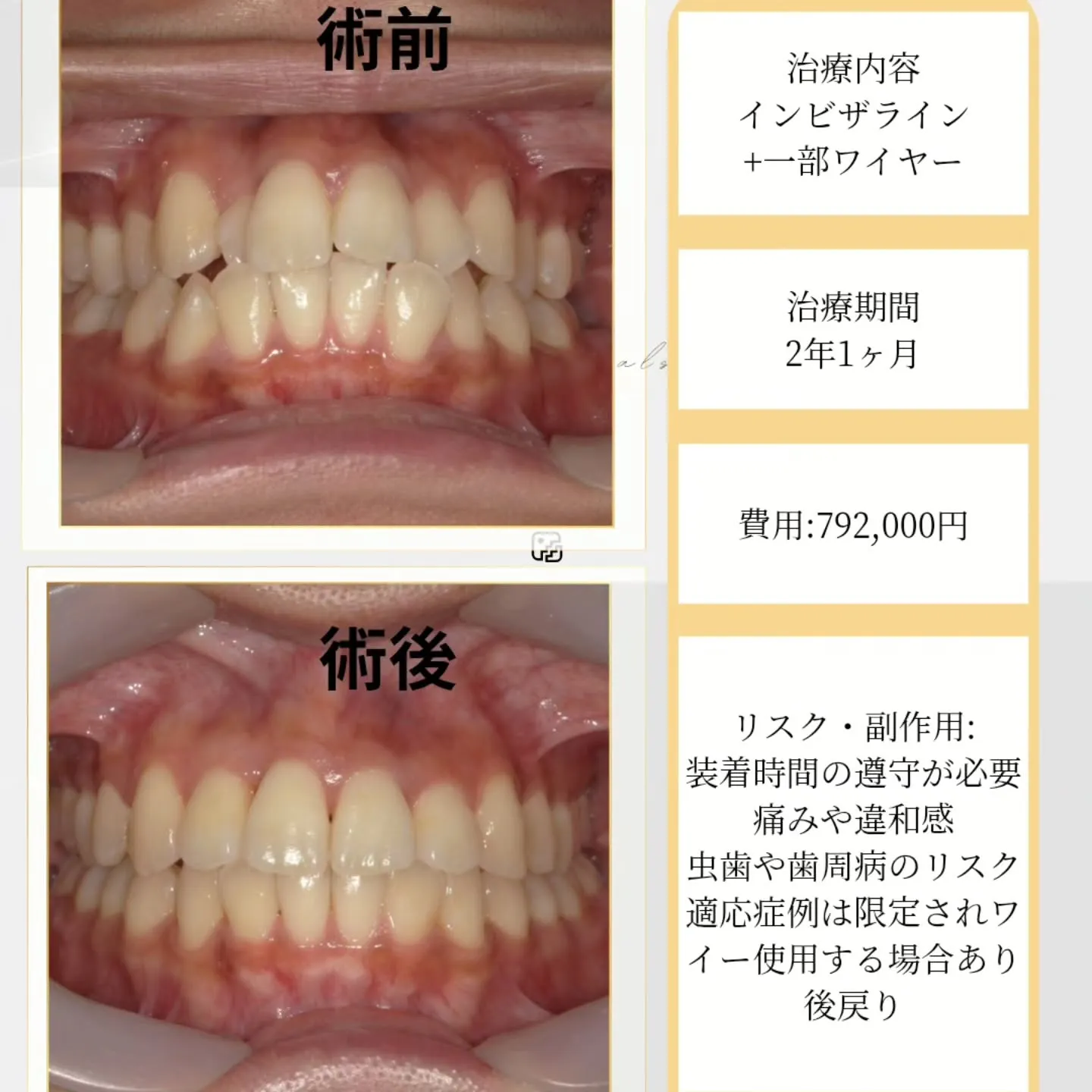 ​【歯並びのお悩み、すっきり解決✨ インビザライン症例】