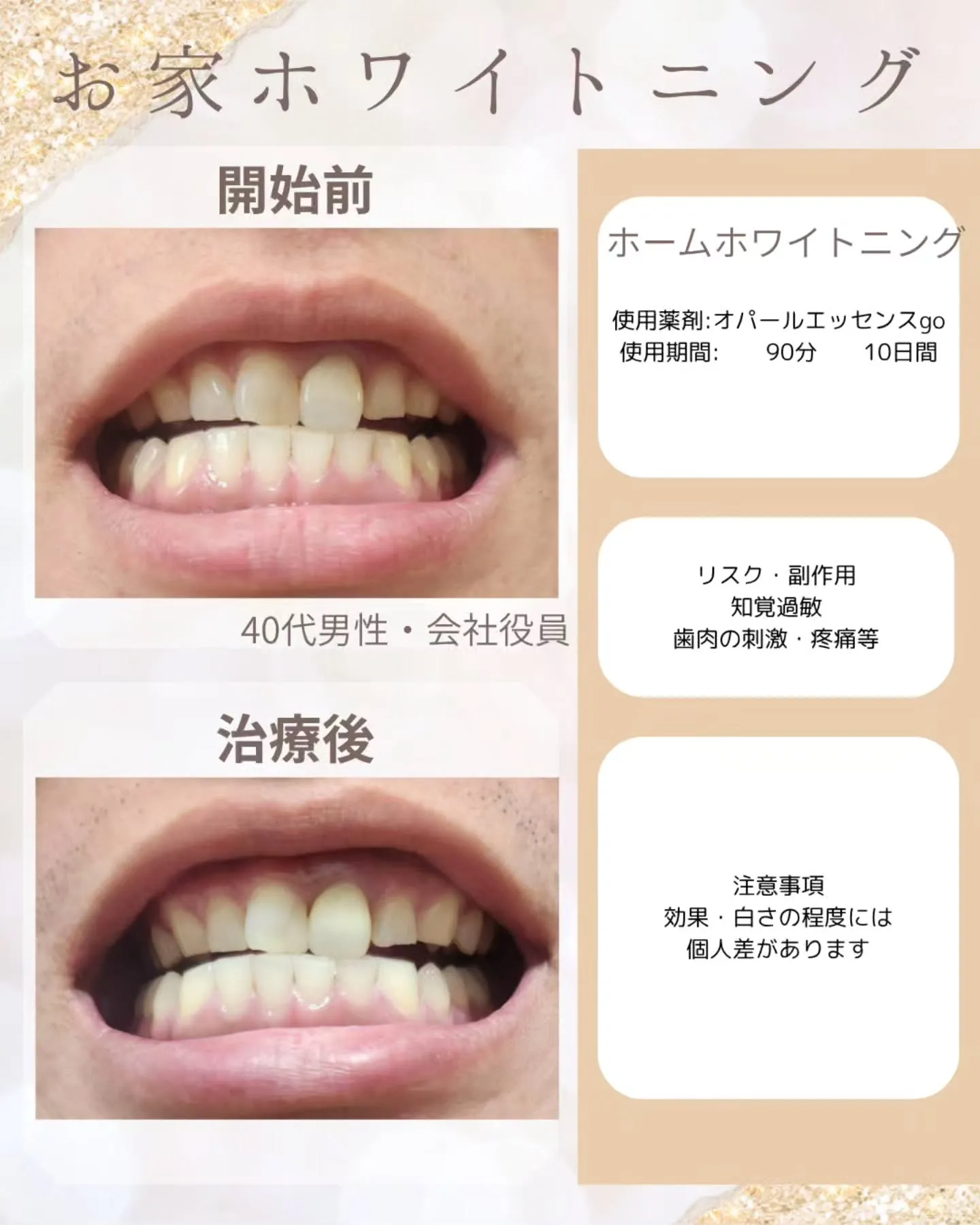 ホームホワイトニングの実際