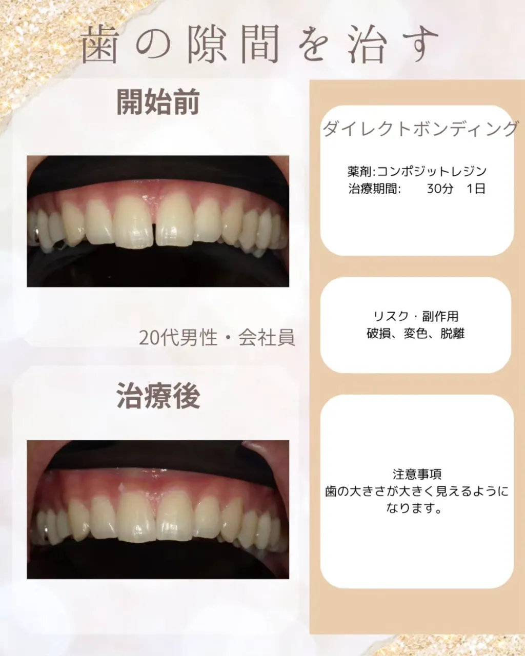 歯の隙間（すきっ歯）が気になって