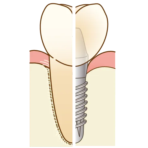 入れ歯が嫌だ、、そんな方へ
